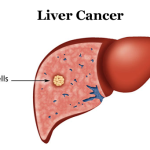 Is-there-a-cure-for-liver-cancer