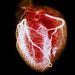 PRinc_rm_arteriogram_of_healthy_heart