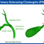Primary-Sclerosing-Cholangitis