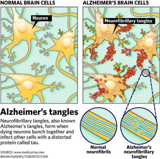 Alzheimer: scoperto l'anello mancante tra la proteina Tau e perdita di  memoria