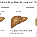 nafld