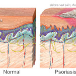 nucleus_rm_photo_of_illustration_of_psoriasis