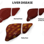 29114856-Malattie-del-fegato-cirrosi-epatica-fegato-grasso-e-il-fegato-normale-Archivio-Fotografico