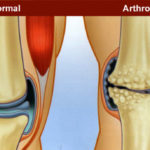 arthrosis050