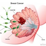 breast-caner