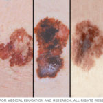 ds00575-melanoma-pictures-for-self-examination