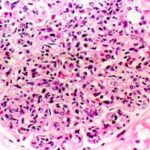 lupus