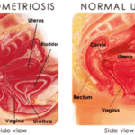 endometriosi