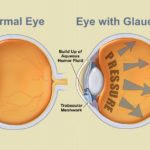 glaucoma
