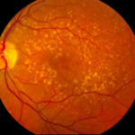 Intermediate_age_related_macular_degeneration