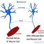 Spinal-muscular-atrophy-treatment-stemcells