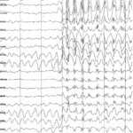 epilepsy