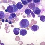 mieloma_multiplo_cellule