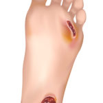 Diabetic foot.