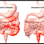 crohns-disease-s5-illustration-of-crohns-disease-and-ulcerative-colitis