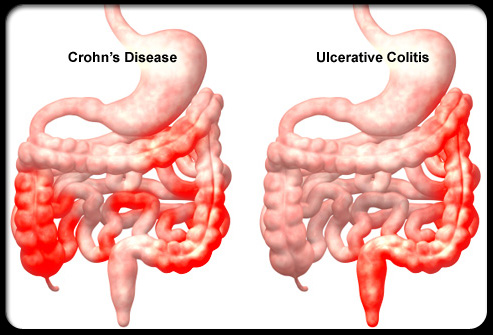 Crohn: presto un trattamento più efficace morbo di Crohn
