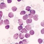 leucemia-linfoblastica-acuta