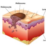 melanoma-cute