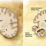 1-alzheimersdi