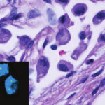 10_17_16bladdercancerposttreatmentlg