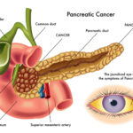 causes-and-symptoms-of-pancreatic-cancer