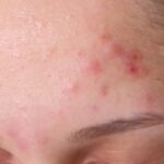 acne-foreheads_1024