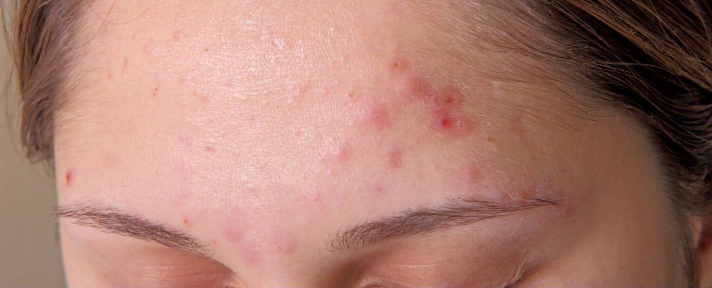 acne-foreheads_1024