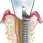 dental-implant-tooth