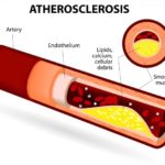 diagram-of-atherosclerosis