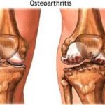 osteoartrite