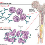 multiple-myeloma-1