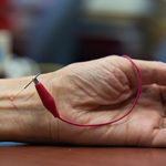 acupuncture_lowers_blood_pressure-350x234