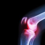an-xray-of-knee-osteoarthritis