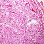 metastatic-hepatocellular-carcinoma-embed