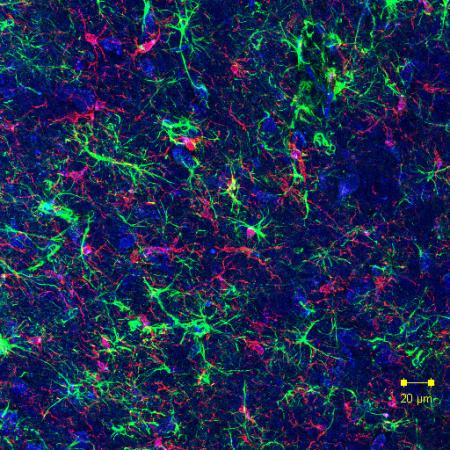 Individuato, per la prima volta, il collegamento tra morbo di Parkinson e microbioma Morbo di Parkinson