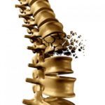 bone-fracture-of-the-spine