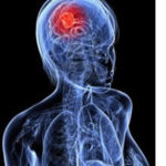 glioma