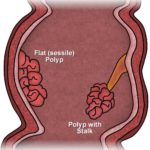 polyps