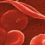 emoglobina-ed-anemia-falciforme