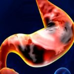 stomach-cancer-breath-test-1