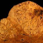 260px-Hepatocellular_carcinoma_1