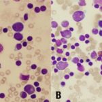 Bone-marrow-in-Diamond-Blackfan-anemia-revealing-a-severe-lack-of-erythroid-precursors