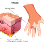 la-vitiligine