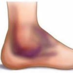lesioni_ematoma_caviglia