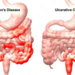 foto_malattie_intestinali_4