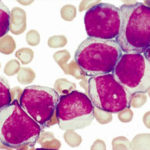 leucemia_39801