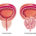 pic-prostate-cancer