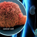 bladder-cancer-s1-illustration-of-bladder-cancer