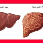 cirrosi-epatica-scompensata_NG1