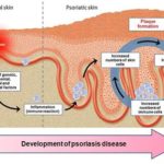 sviluppo_psoriasi2